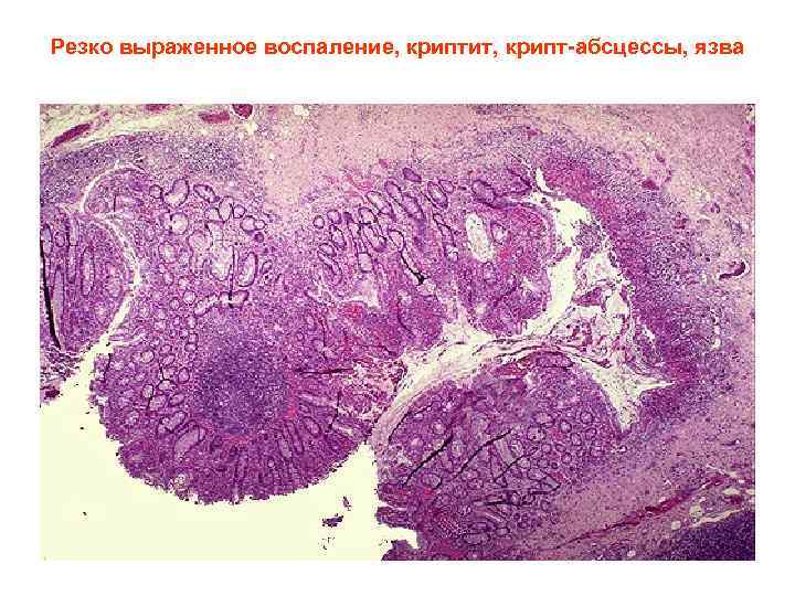 Резко выраженное воспаление, криптит, крипт-абсцессы, язва 