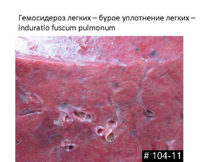 Гемосидероз легких – бурое уплотнение легких – induratio fuscum pulmonum 