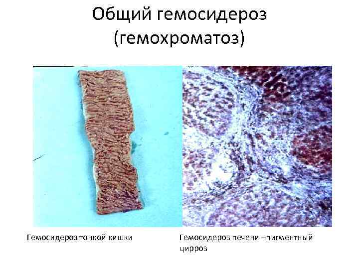Общий гемосидероз (гемохроматоз) Гемосидероз тонкой кишки Гемосидероз печени –пигментный цирроз 