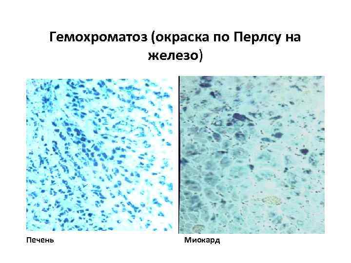 Гемохроматоз (окраска по Перлсу на железо) Печень Миокард 