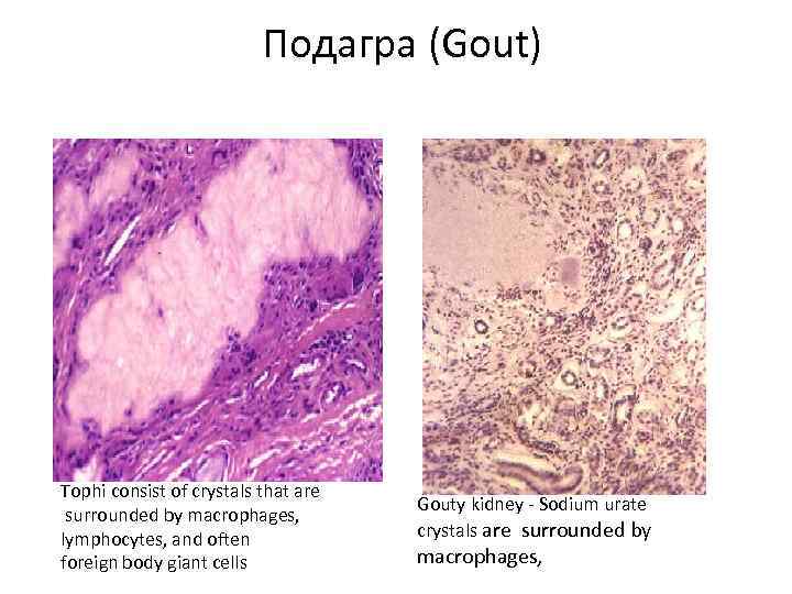 Подагра (Gout) Тophi consist of crystals that are surrounded by macrophages, lymphocytes, and often