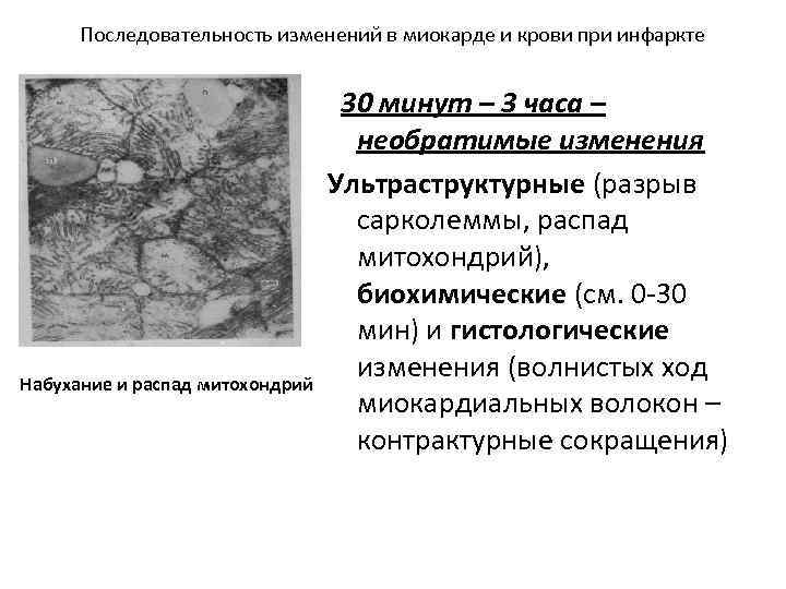 Последовательность изменений в миокарде и крови при инфаркте Набухание и распад митохондрий 30 минут