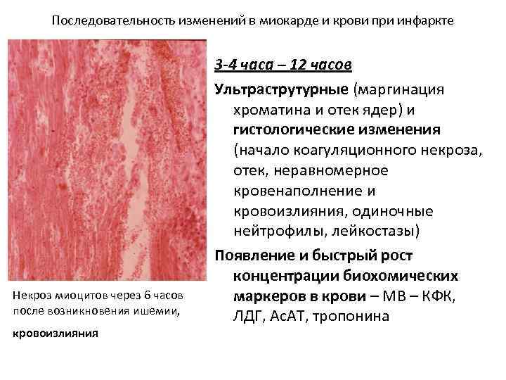Последовательность изменений в миокарде и крови при инфаркте Некроз миоцитов через 6 часов после