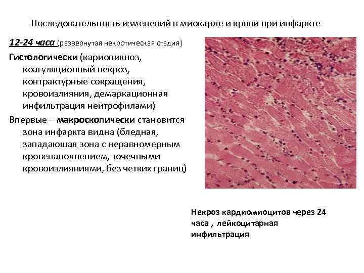 Последовательность изменений в миокарде и крови при инфаркте 12 -24 часа (развернутая некротическая стадия)