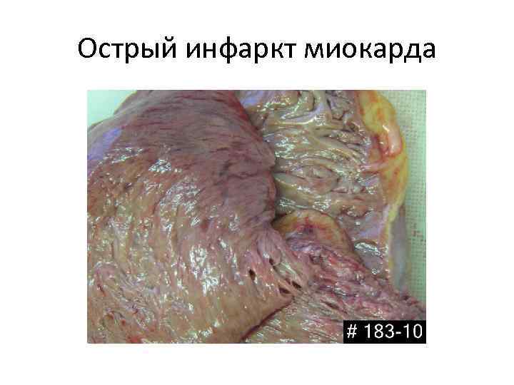 Острый инфаркт миокарда 