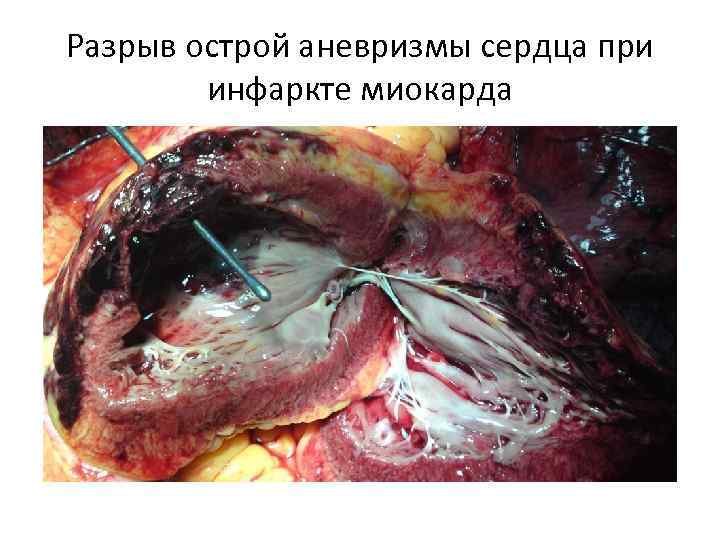Разрыв острой аневризмы сердца при инфаркте миокарда 