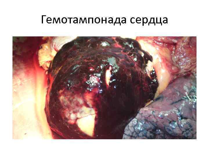 Гемотампонада сердца 