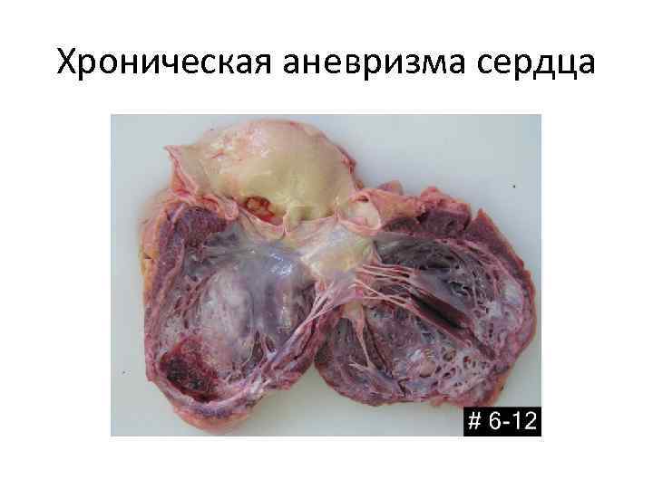 Хроническая аневризма сердца 