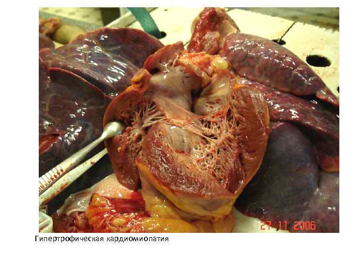 Гипертрофическая кардиомиопатия 