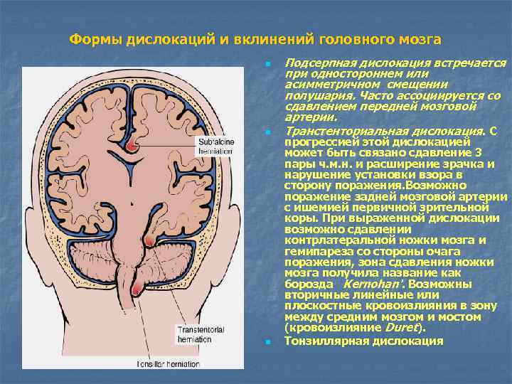 Формы дислокаций и вклинений головного мозга n n n Подсерпная дислокация встречается при одностороннем