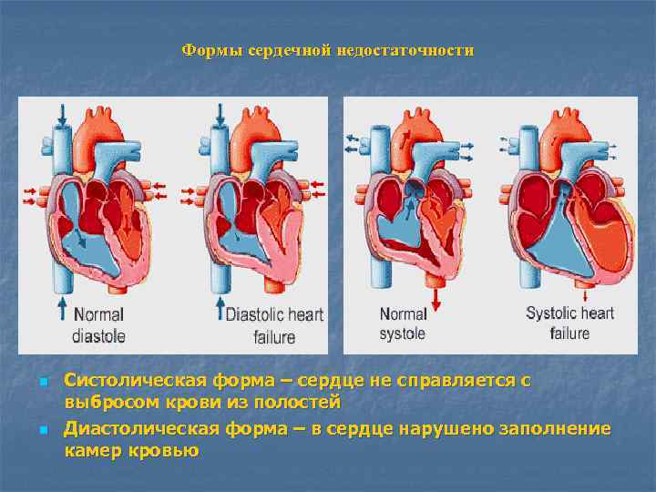 Формы сердечной недостаточности n n Систолическая форма – сердце не справляется с выбросом крови