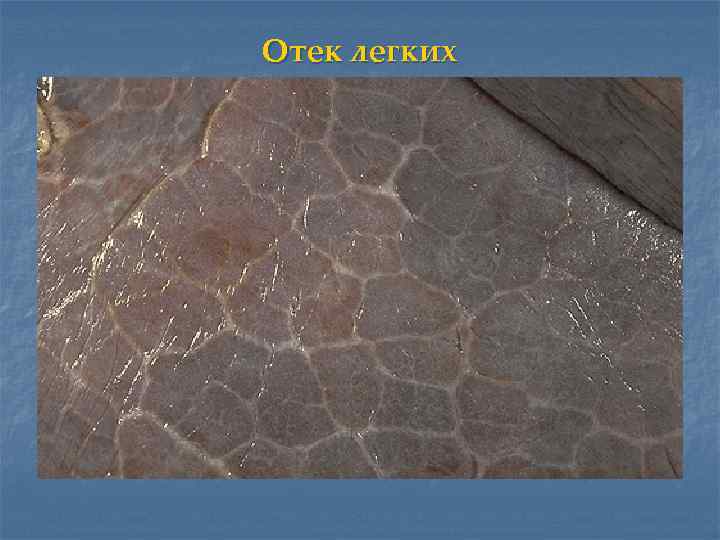 Отек легких 