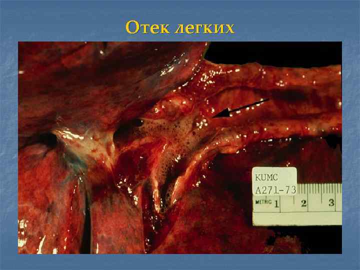 Отек легких 