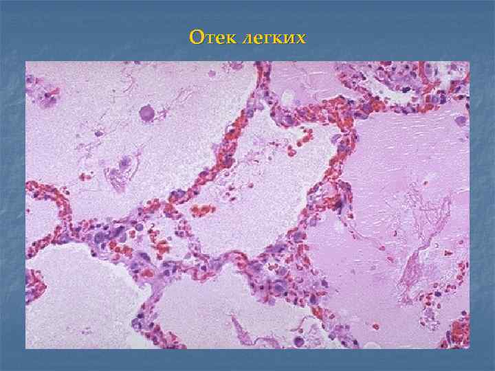 Отек легких 