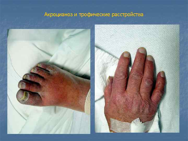 Акроцианоз и трофические расстройства 