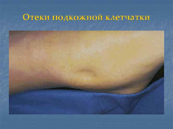 Отеки подкожной клетчатки 