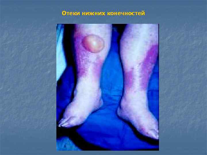 Отеки нижних конечностей 
