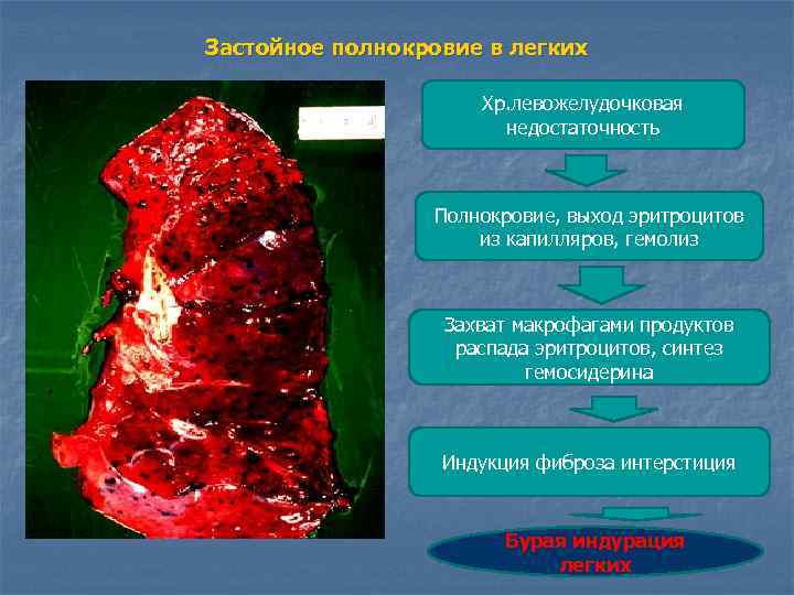 Застойное полнокровие в легких Хр. левожелудочковая недостаточность Полнокровие, выход эритроцитов из капилляров, гемолиз Захват