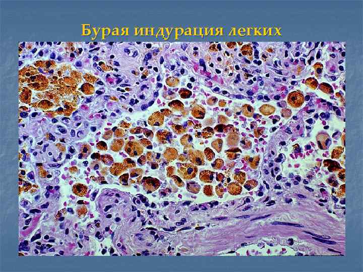 Бурая индурация легких 