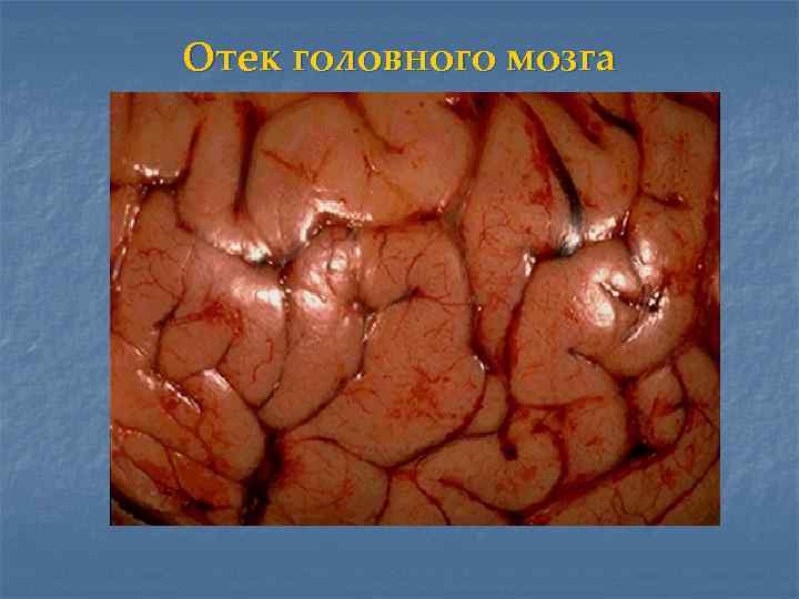 Отек головного мозга 