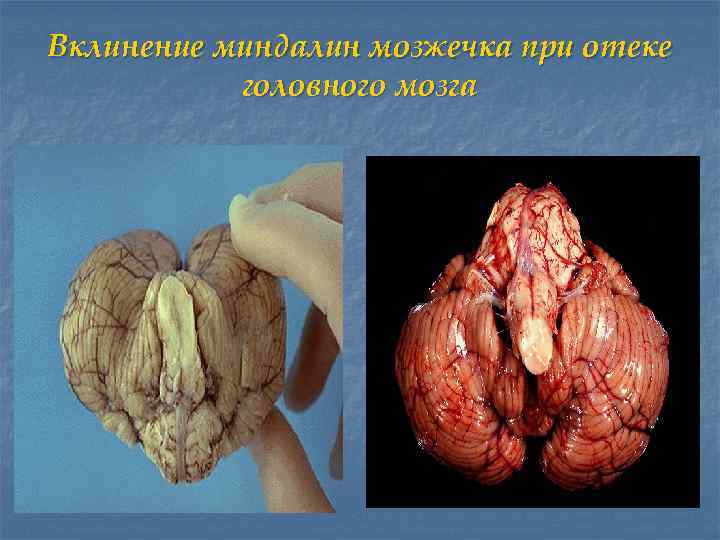 Вклинение миндалин мозжечка при отеке головного мозга 