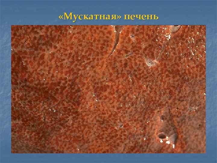  «Мускатная» печень 