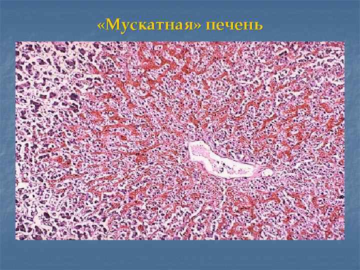  «Мускатная» печень 