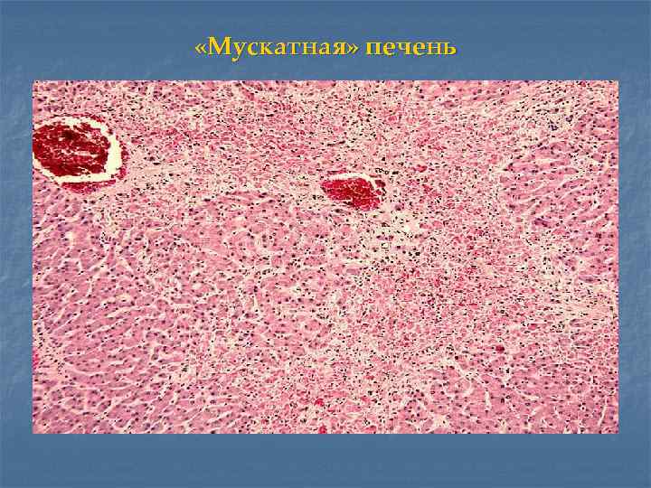  «Мускатная» печень 