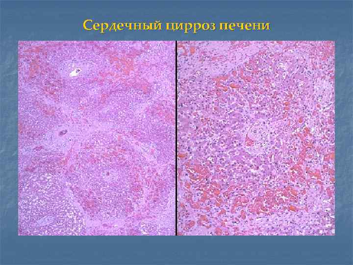 Сердечный цирроз печени 