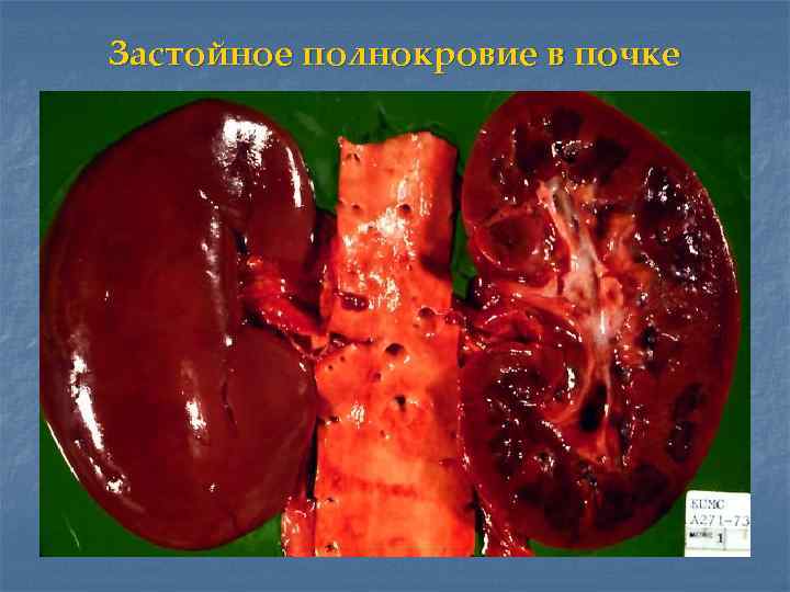 Застойное полнокровие в почке 