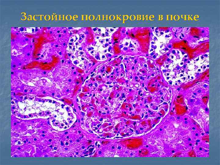 Застойное полнокровие в почке 
