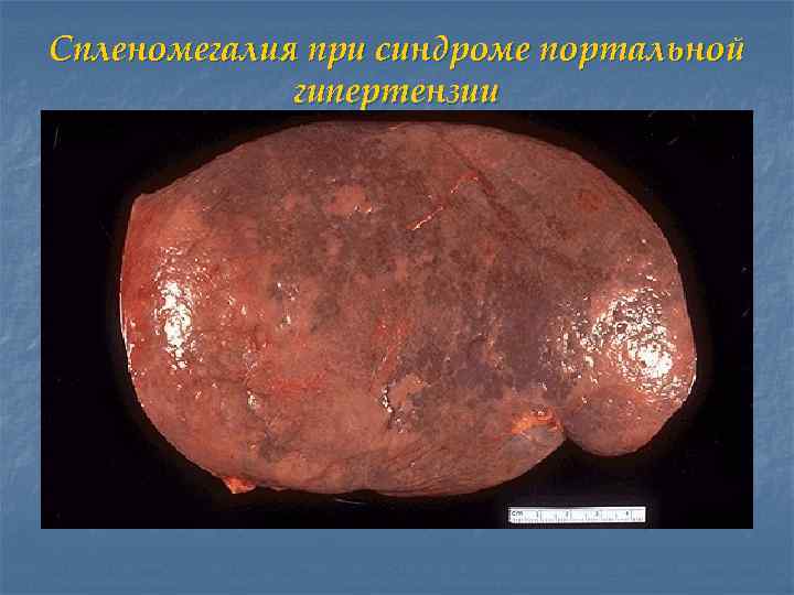 Спленомегалия при синдроме портальной гипертензии 