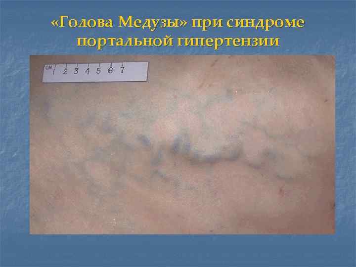  «Голова Медузы» при синдроме портальной гипертензии 