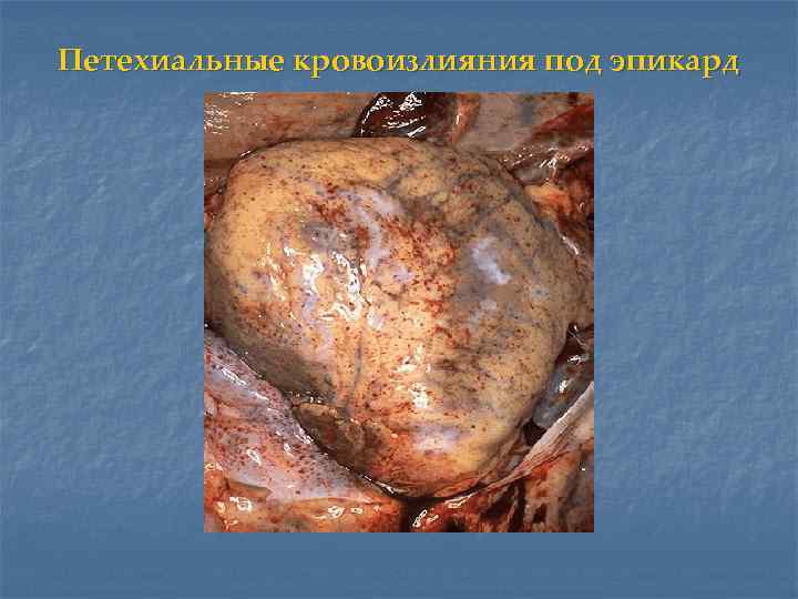 Петехиальные кровоизлияния под эпикард 