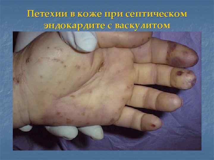 Петехии в коже при септическом эндокардите с васкулитом 