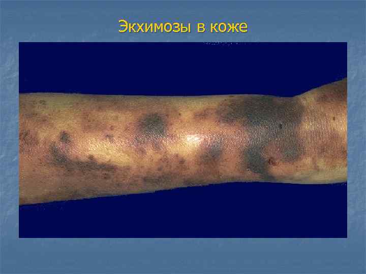 Экхимозы в коже 