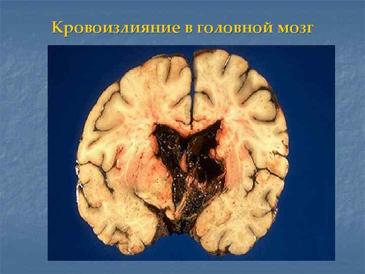 Кровоизлияние в головной мозг 