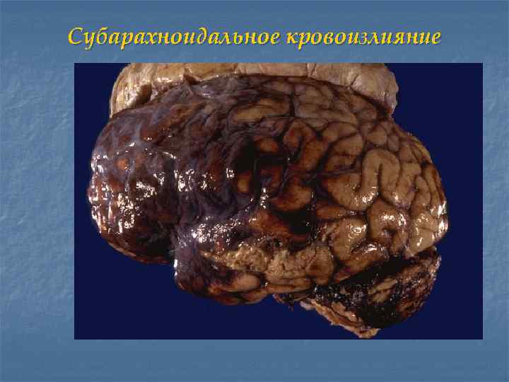 Субарахноидальное кровоизлияние 