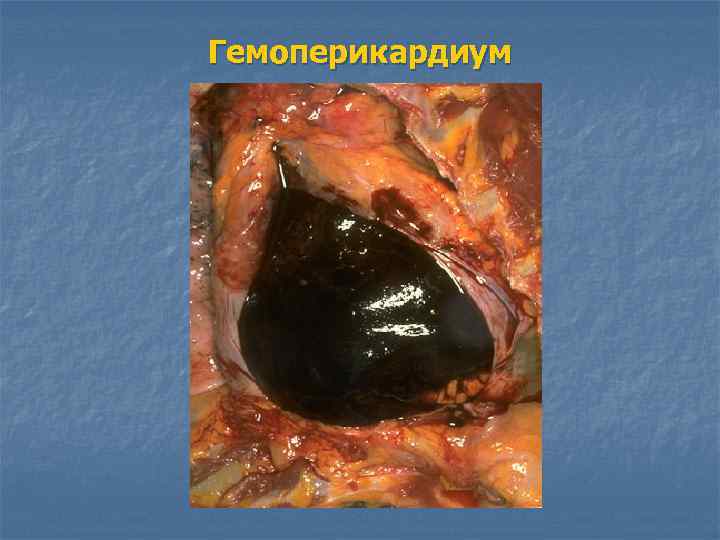 Гемоперикардиум 
