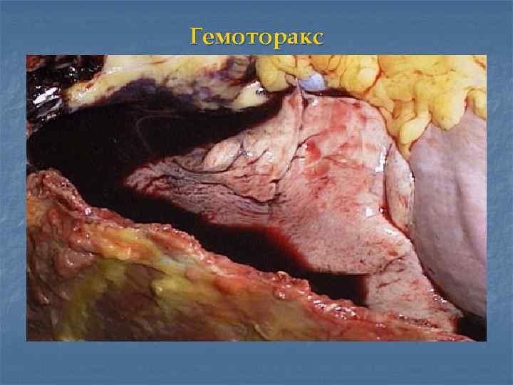 Гемоторакс 