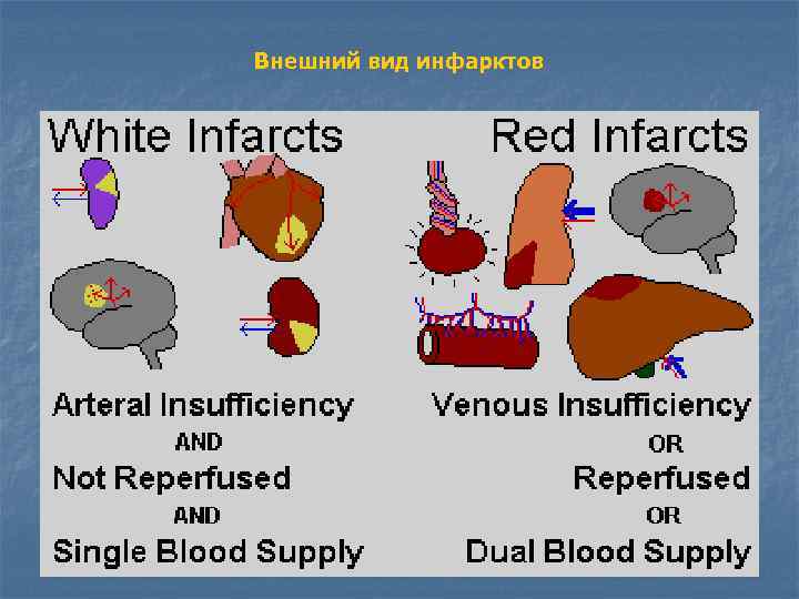 Внешний вид инфарктов 