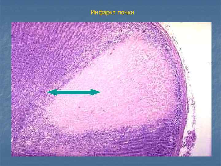 Инфаркт почки 