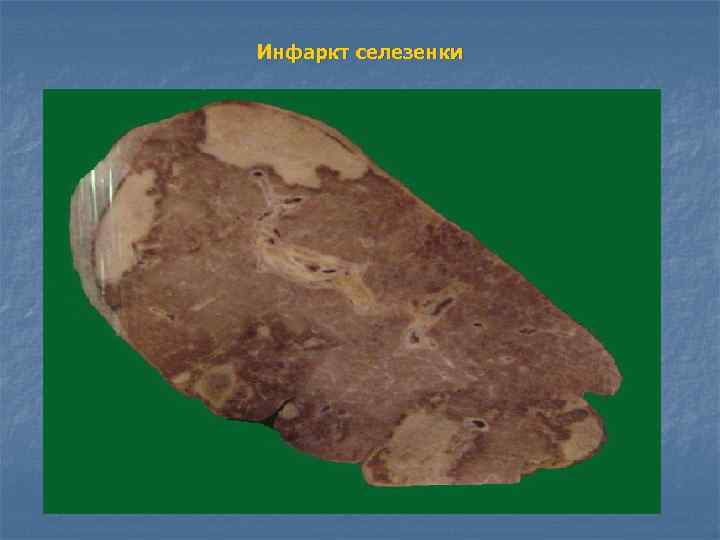 Инфаркт селезенки 