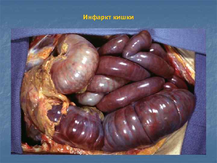 Инфаркт кишки 