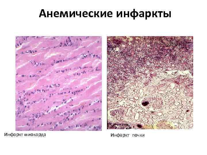 Анемические инфаркты Инфаркт миокарда Инфаркт почки 