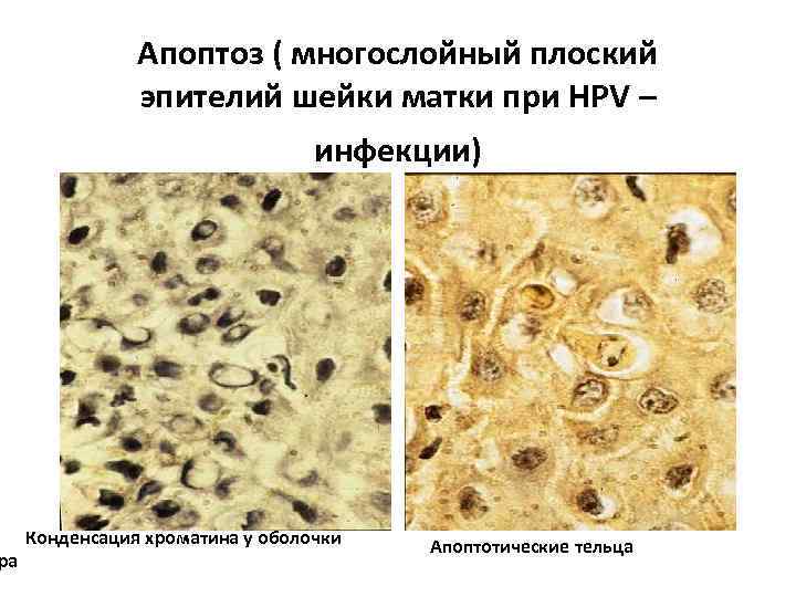 Апоптоз ( многослойный плоский эпителий шейки матки при НРV – инфекции) Конденсация хроматина у