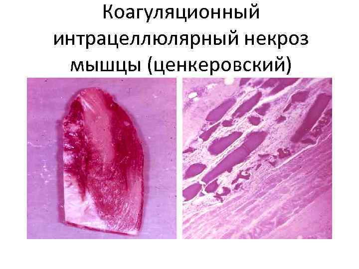 Коагуляционный интрацеллюлярный некроз мышцы (ценкеровский) 