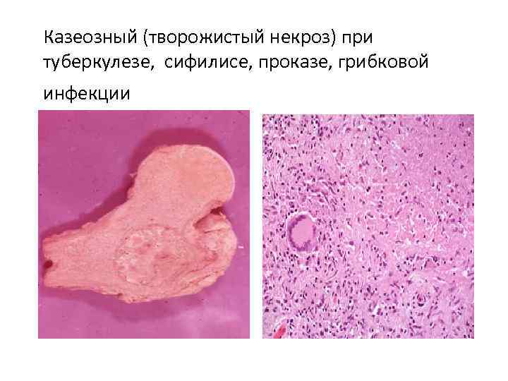 Казеозный (творожистый некроз) при туберкулезе, сифилисе, проказе, грибковой инфекции 