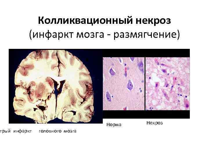 Колликвационный некроз (инфаркт мозга - размягчение) трый инфаркт головного мозга Норма Некроз 