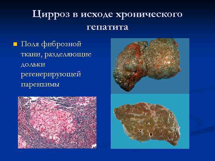 Цирроз в исходе хронического гепатита n Поля фиброзной ткани, разделяющие дольки регенерирующей паренхимы 